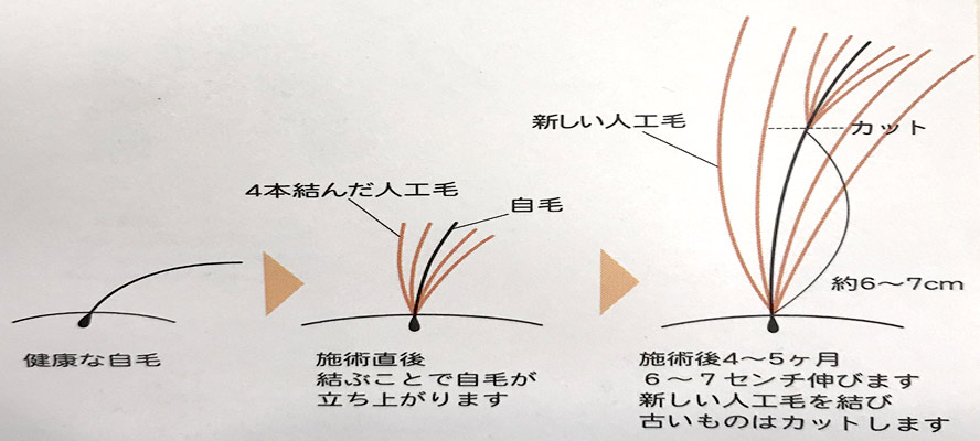 特許増毛技術 | カット＆エステBonny